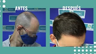 🙋‍‍ CASO REAL Injerto Capilar antes y después  3581 UFS  Resultados increíbles 👏‍‍ [upl. by Ehc]