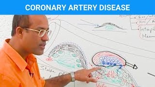 Coronary Artery Disease  Ischemic Heart Disease  Angina🫀 [upl. by Yedsnil632]