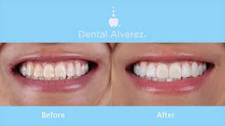 Injected resin veneers [upl. by Aliet965]