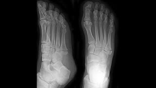 5th Metatarsal Base Fracture Foot [upl. by Narcissus]