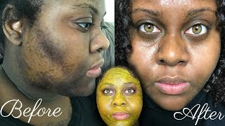 5 DAY TURMERIC FACE MASK CLEARED MY HYPERPIGMENTATION IM SHOOK [upl. by Akitnahs]