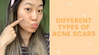 Different Types of Acne Scars  FaceTory [upl. by Huda]