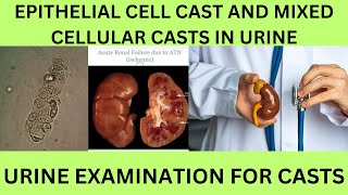 EPITHELIAL CELL CAST AND MIXED CELL CAST IN THE URINE CAUSES SYMPTOMS AND TREATMENT [upl. by Enier]