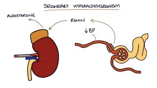 Hyperaldosteronism and Conns Syndrome [upl. by Enirahtak]