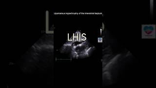 Lipomatous Hypertrophy of Interatrial Septum echocardiography 심장초음파 heart sonography tte [upl. by Lance831]