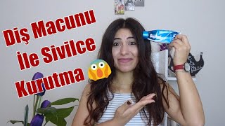 Diş Macunu İle Sivilce İyileştirmek 😵 [upl. by Ecinrev961]