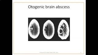 Complications of Otitis Media 5 Brain Abscess [upl. by Amisoc]