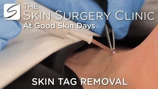 Skin Tag Removal  Watch the Procedure [upl. by Samford924]