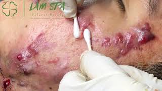 Treatment of acne pustules severe inflammation  Điều trị mụn mủ viêm nặng  LAMSPA PHUQUOC L P11 [upl. by Celio139]