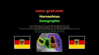 Sonographie  Harnaufstau [upl. by Anelram309]