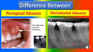 Difference Between Periapical Abscess and Periodontal Abscess [upl. by Rogergcam644]