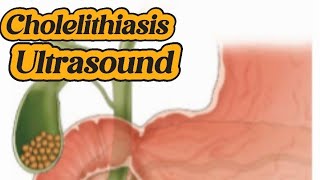 Gallstones  Cholelithiasis  calcified wall  cholecystitis  Sludge  Liver Ultrasound [upl. by Eduam651]