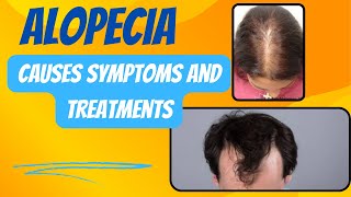 Alopecia causessymptoms and treatments। Alopecia Areata। preferred solution [upl. by Itoyj]