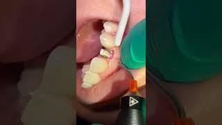 DentaLaze used for Gingivectomy Around an Implant [upl. by Inihor810]