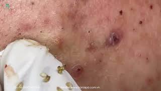 Big Cystic Acne Blackheads Extraction Blackheads amp Milia Whiteheads Removal Pimple Popping [upl. by Lucey]