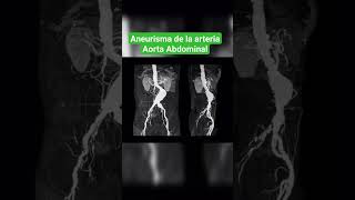 ANEURISMA DE LA ARTERIA AORTA ABDOMINAL ANGIOGRAFÍA [upl. by Nraa]