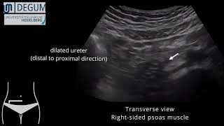 Episode 37 NephroUrolithiasis [upl. by Ahsasal]