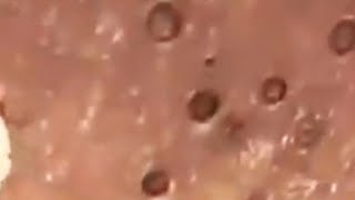 blackhead removal [upl. by Itin]