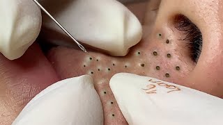 Big Cystic Acne Blackheads Extraction Blackheads amp Milia Whiteheads Removal Pimple Popping  9150 [upl. by Yelak471]