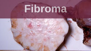 Ovarian Fibroma  Pathology mini tutorial [upl. by Attebasile]