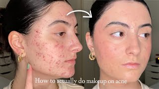 How to Make Makeup Look Smooth amp Natural on Acne and Textured Skin [upl. by Espy]