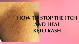 HOW TO HEAL KETO RASH [upl. by Juno361]