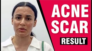 Testimonials Effective Treatments for Acne Scars and Pigmentation Sakhiya Skin Clinic Review [upl. by Alaehcim]