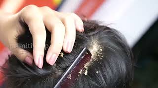 dandruff removal huge flakes scratching on head17 [upl. by Behl]