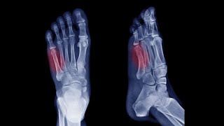 5th METATARSAL FRACTURE putturkattu FRACTURE anekalputturkattu [upl. by Jock]