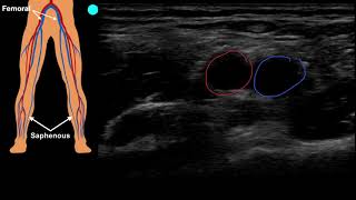 POCUS Venous Access  Part 1 [upl. by Lesley572]