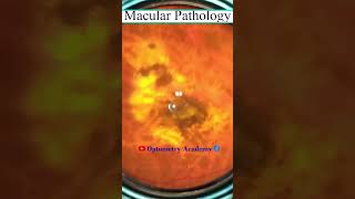 Macular Pathology  macular scar  Fundus Videography  Fundus Photography  Short Video 169 viral [upl. by Anifesoj]