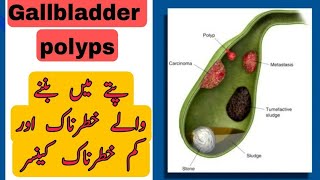 Gallbladder Mass or polyps  treatment  Urdu Hindi [upl. by Tsenre436]