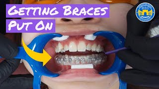 Process of Getting Braces [upl. by Nedda349]