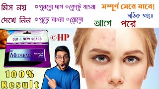 Mederma cream  mederma for acne scars  mederma advanced scar gel review [upl. by Barton140]