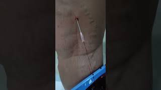 varicosevein unani varicoseveinstreatment drhussain Greekcliniccom nosurgery [upl. by Ateinotna291]