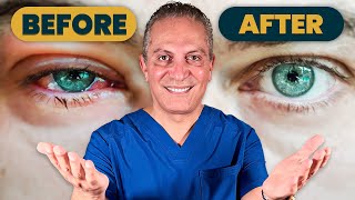 How to Get Rid of Blepharitis in 2024  Top 2 Treatments by Eye Doctor [upl. by Smallman699]