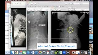 Kyphosis Xray Measurements amp Lordosis ChangesScheuermanns [upl. by Poppy517]