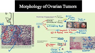 Morphology of Ovarian Tumors Special Pathology DrMUsman [upl. by Arundell]