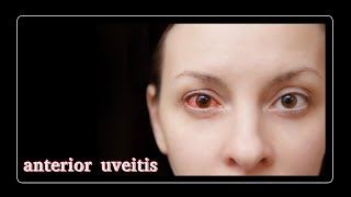 anterior uveitis [upl. by Ecital976]