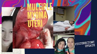 HYSTERECTOMY 5 DAYS POST OP UPDATECRISKATH [upl. by Inor]