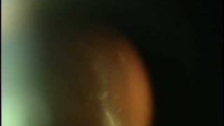 Eye Floaters Scott Geller MD Fort Myers Florida [upl. by Ilysa]