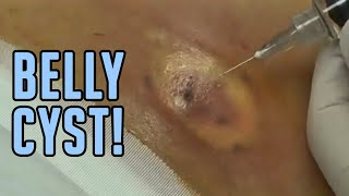 The Tummy Cyst  Busted [upl. by Innoj579]