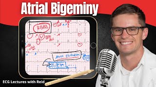 Atrial Bigeminy EKG  ECG Lecture [upl. by Hsepid609]