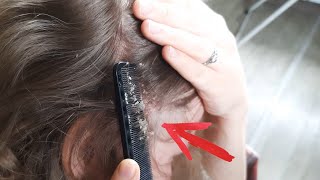 My psoriasis follow up Flakes scratch Shave your hair to bald girl [upl. by Ruthven]