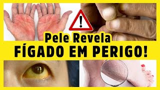 15 SINAIS NA PELE QUE REVELAM PROBLEMAS NO FÍGADO  com Dr Alain Dutra [upl. by Odie]