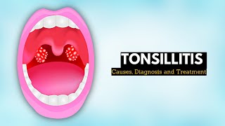 Tonsillitis Causes Signs and Symptoms Diagnosis and Treatment [upl. by Ellednahs]