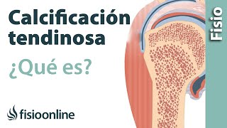 Calcificación tendinosa  Qué es causas síntomas y tratamiento [upl. by Yziar459]