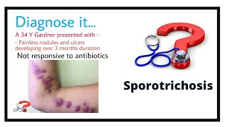 Sporotrichosis much more than skin [upl. by Yawnoc]