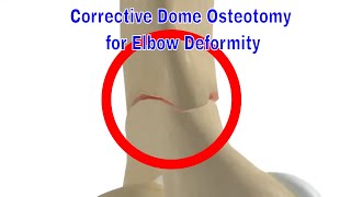 Corrective Dome Osteotomy for Cubitus Varus and Valgus Deformity [upl. by Ynohtnael]