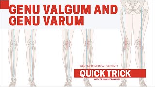 GENU VALGUM VS GENU VARUM Mnemonic Series EPISODE 02 [upl. by Lalita]